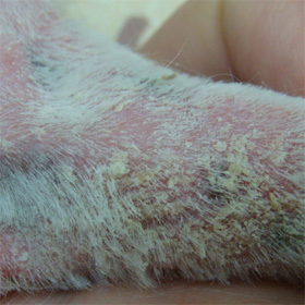 大量の鱗屑を伴った重度の脂漏性皮膚炎